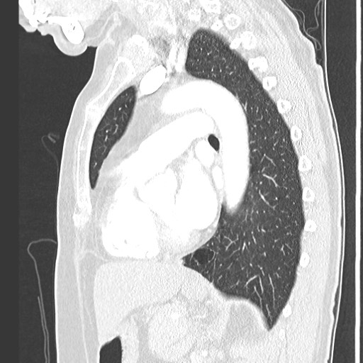 Amyloidosis - bronchial and diffuse nodular pulmonary involvement (Radiopaedia 60156-67745 Sagittal lung window 53).jpg