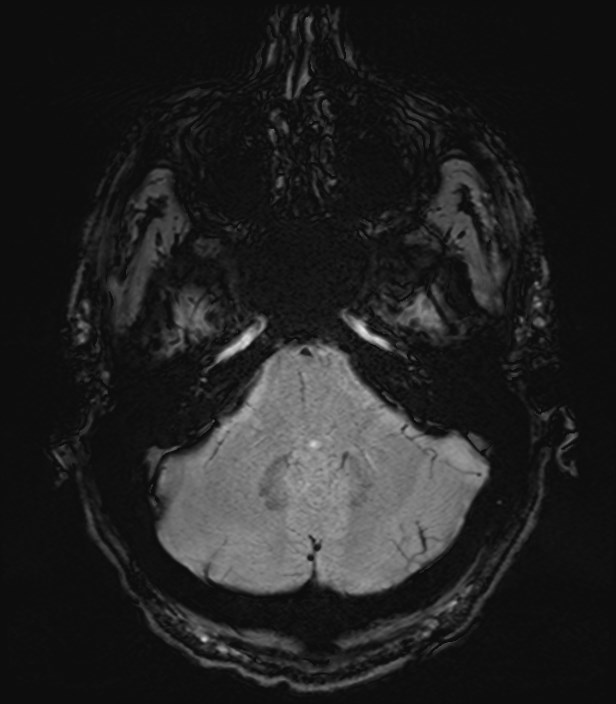 Amyotrophic lateral sclerosis (Radiopaedia 87352-103658 Axial SWI 6).jpg