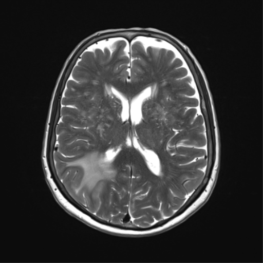 File:Anaplastic astrocytoma (Radiopaedia 86943-103160 Axial T2 23).png