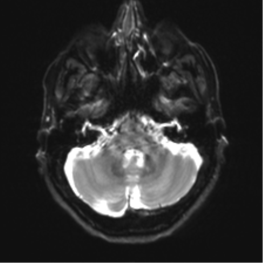 Anaplastic astrocytoma - thalamic glioma (Radiopaedia 59709-67115 Axial DWI 8).png