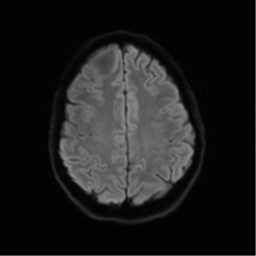 Anaplastic astrocytoma IDH mutant (Radiopaedia 50046-55341 Axial DWI 48).png
