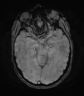 File:Anaplastic astrocytoma IDH mutant (Radiopaedia 50046-55341 Axial SWI 36).png