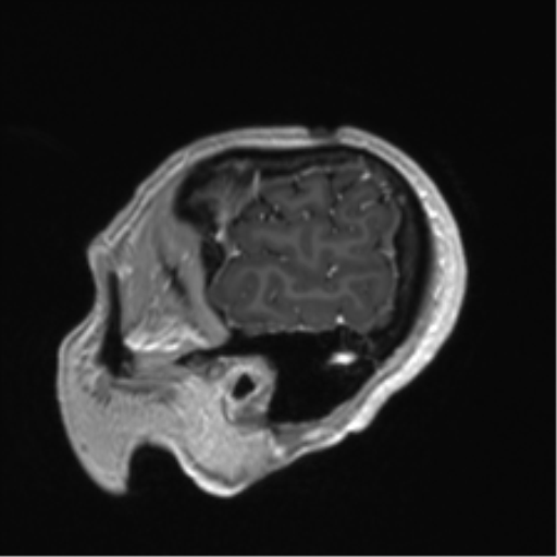 Anaplastic astrocytoma IDH mutant (Radiopaedia 50046-55341 Sagittal T1 C+ 53).png