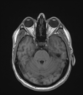 Anaplastic astrocytoma IDH wild-type (Radiopaedia 49984-55273 Axial T1 19).png