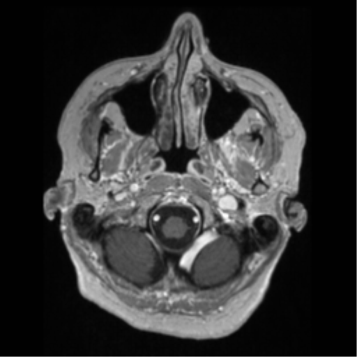 File:Anaplastic astrocytoma IDH wild-type (pseudoprogression) (Radiopaedia 42209-45276 Axial T1 C+ 21).png