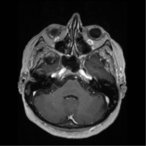 File:Anaplastic astrocytoma IDH wild-type (pseudoprogression) (Radiopaedia 42209-45276 Axial T1 C+ 41).png