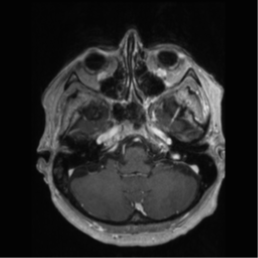 File:Anaplastic astrocytoma IDH wild-type (pseudoprogression) (Radiopaedia 42209-45277 Axial T1 C+ 23).png
