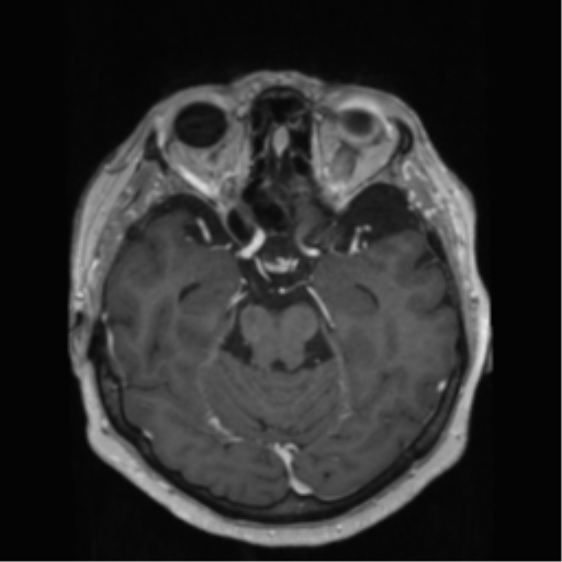 File:Anaplastic astrocytoma IDH wild-type (pseudoprogression) (Radiopaedia 42209-45278 Axial T1 C+ 63).png