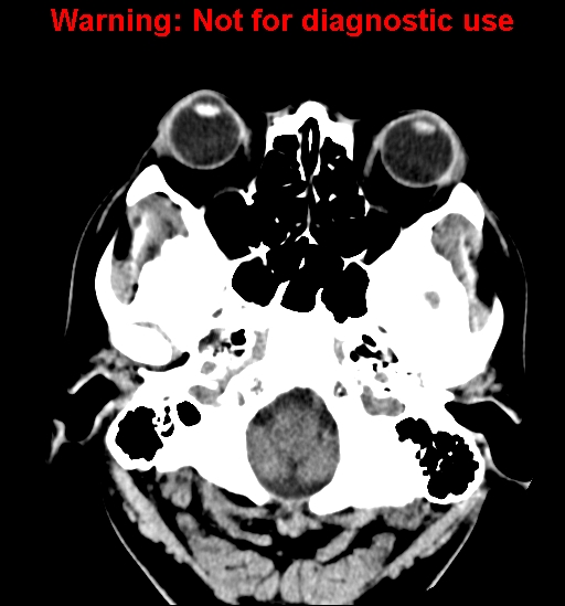 File:Anaplastic ganglioglioma (Radiopaedia 44921-48815 Axial non-contrast 3).jpg