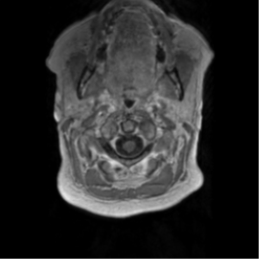 Anaplastic oligodendroglioma (Radiopaedia 83500-98599 Axial T1 C+ 1).png