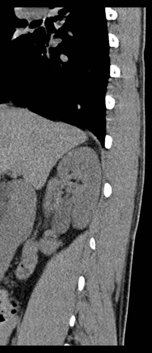 Aneurysmal bone cyst T11 (Radiopaedia 29294-29721 E 70).jpg