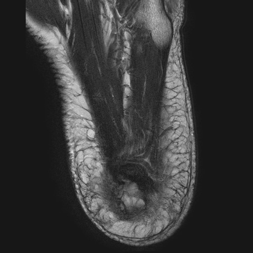 File:Aneurysmal bone cyst of the calcaneus (Radiopaedia 60669-68420 Axial T2 2).jpg
