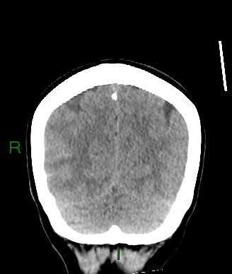 File:Aneurysmal subarachnoid hemorrhage with intra-axial extension (Radiopaedia 84371-99699 Coronal non-contrast 18).jpg