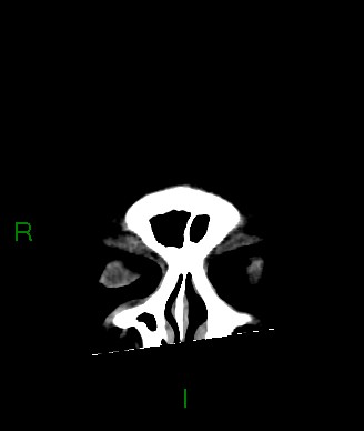 Aneurysmal subarachnoid hemorrhage with intra-axial extension (Radiopaedia 84371-99699 Coronal non-contrast 63).jpg