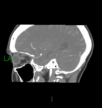 File:Aneurysmal subarachnoid hemorrhage with intra-axial extension (Radiopaedia 84371-99732 B 21).jpg