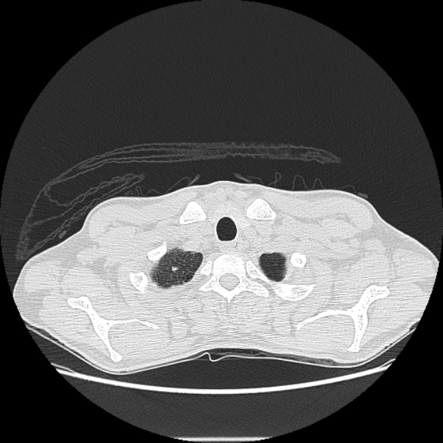 Angioinvasive aspergellosis (Radiopaedia 66995-76315 Axial lung window 1).jpg