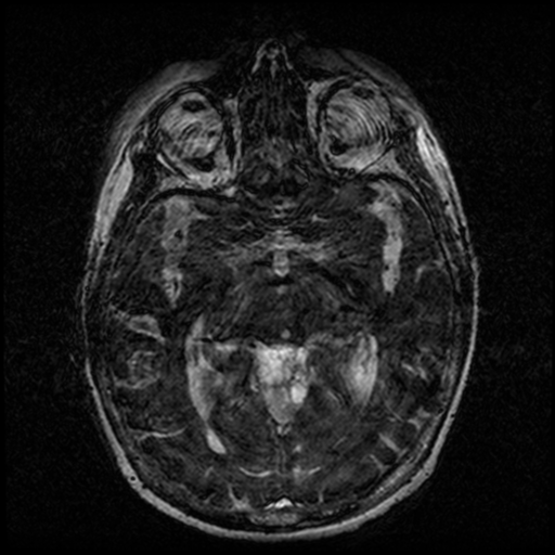 Angioinvasive aspergillosis in the pituitary fossa (Radiopaedia 39676-42010 Ax 3D FIESTA VOLUME 78).png