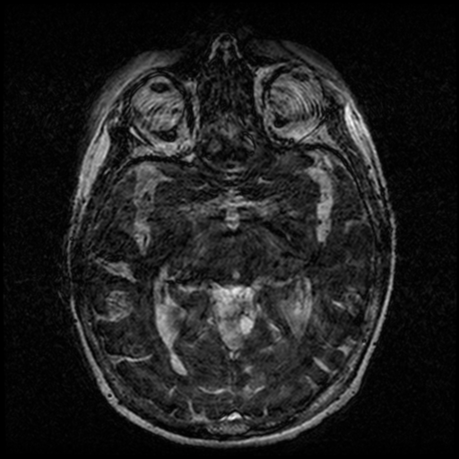Angioinvasive aspergillosis in the pituitary fossa (Radiopaedia 39676-42010 Ax 3D FIESTA VOLUME 79).png