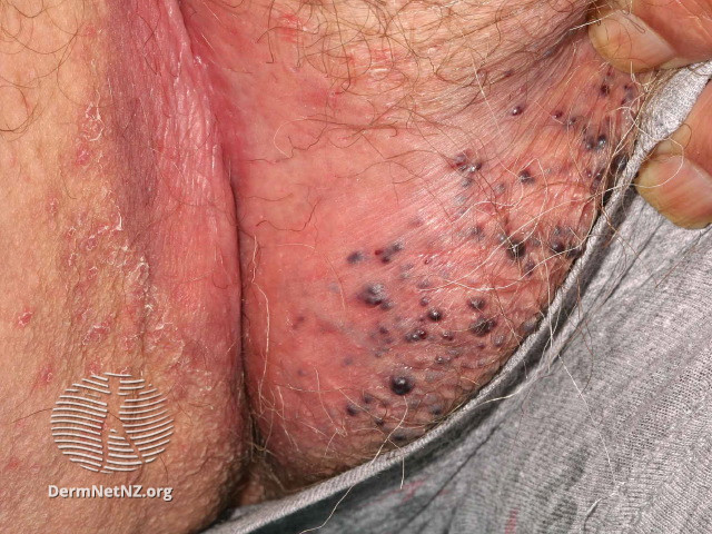 File:Angiokeratoma of Fordyce on vulva (DermNet NZ angiokeratoma-26).jpg
