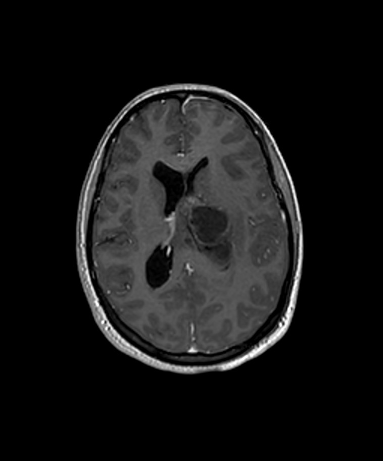Angiomatous meningioma (Radiopaedia 79459-92577 Axial T1 C+ 3D ISO 12).jpg