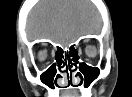 Angular dermoid cyst (Radiopaedia 88967-105790 Coronal non-contrast 28).jpg