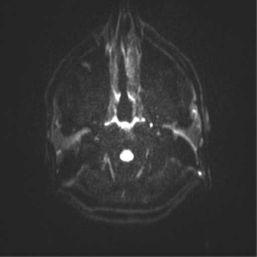 Angular epidermoid cyst (Radiopaedia 46908-51438 Axial DWI 78).png