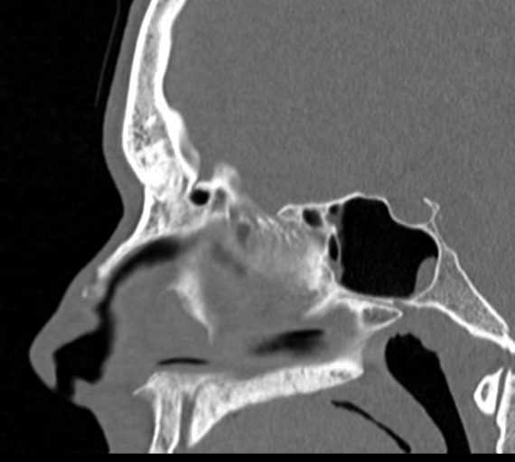 Angular epidermoid cyst (Radiopaedia 46908-51439 Sagittal bone window 43).png