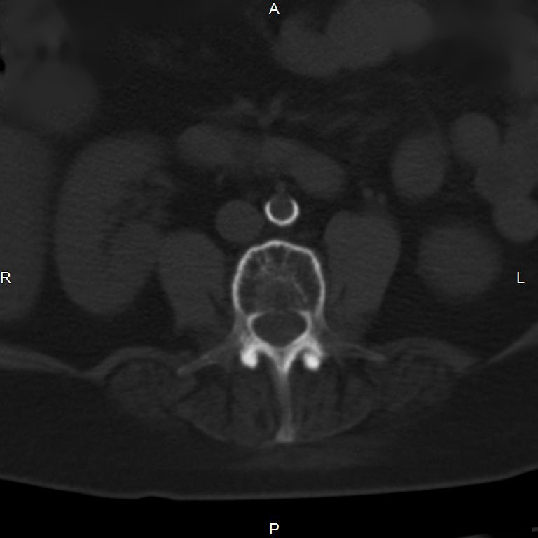 Ankylosing spondylitis (Radiopaedia 8748-9556 Axial bone window 33).jpg