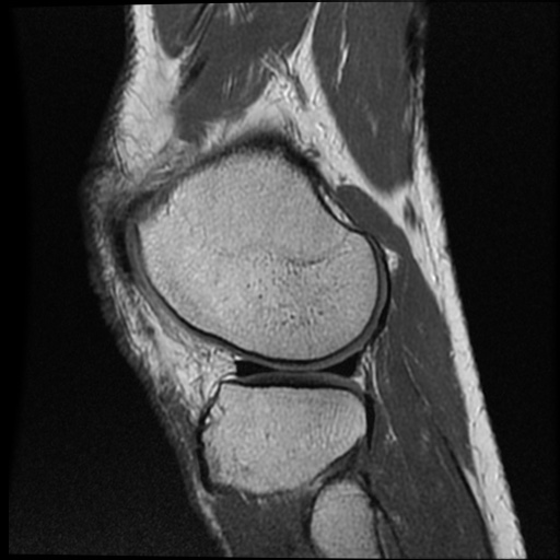 File:Anomalous insertion of the medial meniscus (Radiopaedia 77559-89721 Sagittal PD 15).jpg