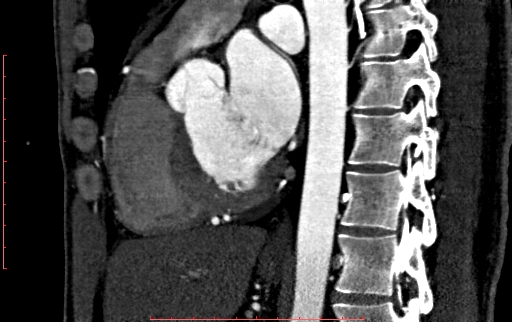 File:Anomalous left coronary artery from the pulmonary artery (ALCAPA) (Radiopaedia 70148-80181 C 130).jpg