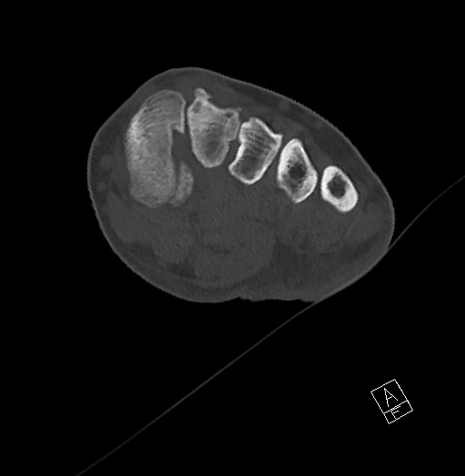 Anterior calcaneal process fracture (Radiopaedia 63353-71943 Axial bone window 71).jpg