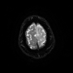 Anterior cerebral artery infarction (Radiopaedia 46794-51323 Axial DWI 53).jpg