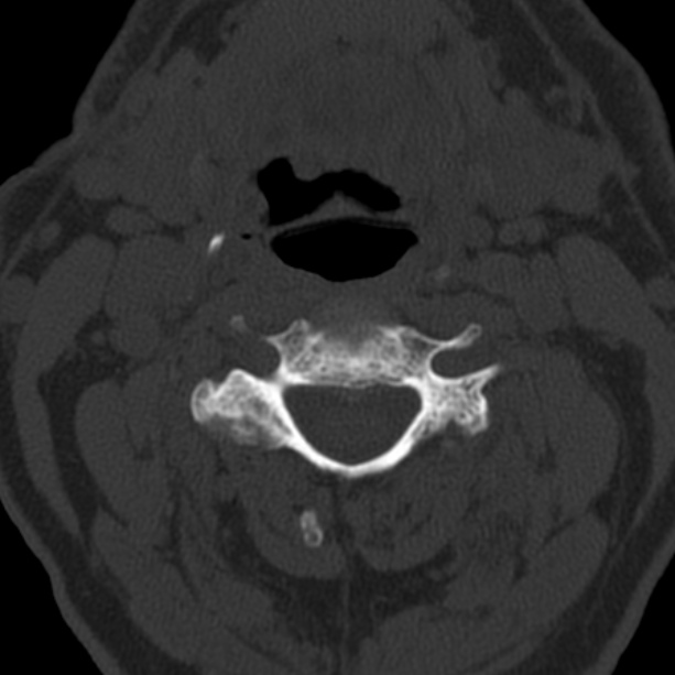 Anterior cervical postdiscectomy arthrodesis (Radiopaedia 32678-33646 Axial bone window 33).jpg