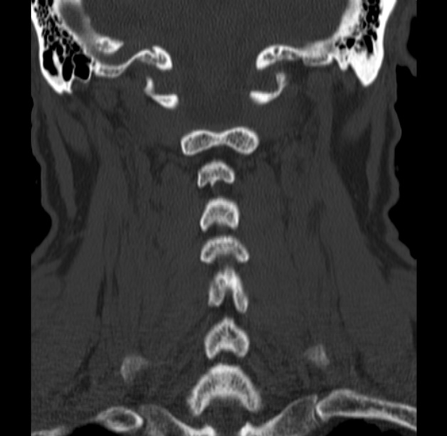 Anterior cervical postdiscectomy arthrodesis (Radiopaedia 32678-33646 Coronal bone window 47).jpg