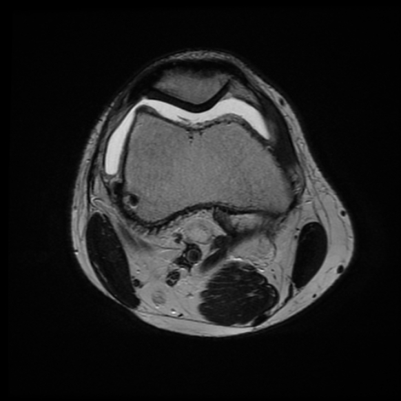 File:Anterior cruciate ligament graft tear and bucket-handle tear of medial meniscus (Radiopaedia 75867-87255 Axial T2 19).jpg