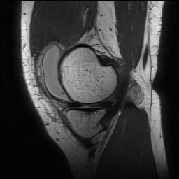 Anterior cruciate ligament rupture with Segond fracture (Radiopaedia 69043-78806 Sagittal PD 48).jpg