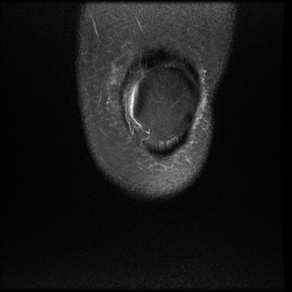 File:Anterior cruciate ligament tear, Wrisberg rip and bucket-handle tear of medial meniscus (Radiopaedia 75872-87266 Coronal PD fat sat 3).jpg