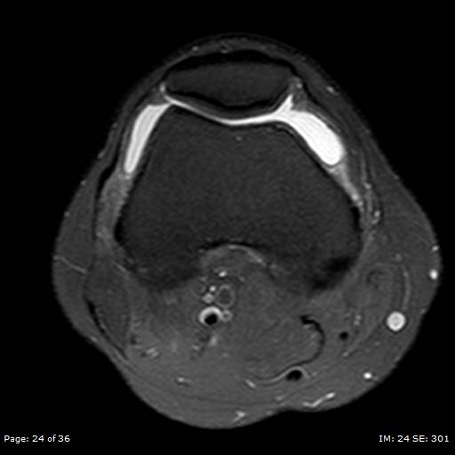 File:Anterior cruciate ligament tear (Radiopaedia 70783-80964 Axial PD fat sat 24).jpg