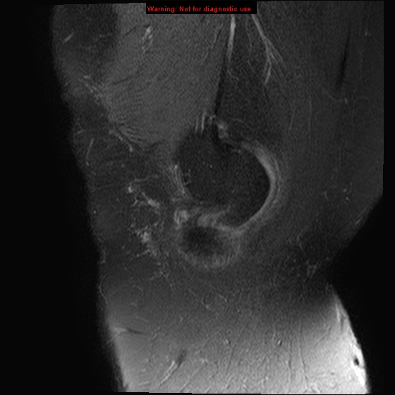 File:Anterior cruciate ligament tear - complete (Radiopaedia 12175-12514 Sagittal T2 fat sat 20).jpg