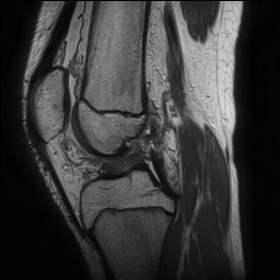 File:Anterior cruciate ligament tear - pediatric (Radiopaedia 62152-70260 Sagittal PD 87).jpg