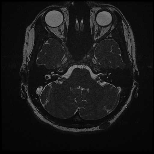 Anterior inferior cerebellar artery vascular loop - type II (Radiopaedia 70991-81209 Axial 3D FIESTA 39).jpg