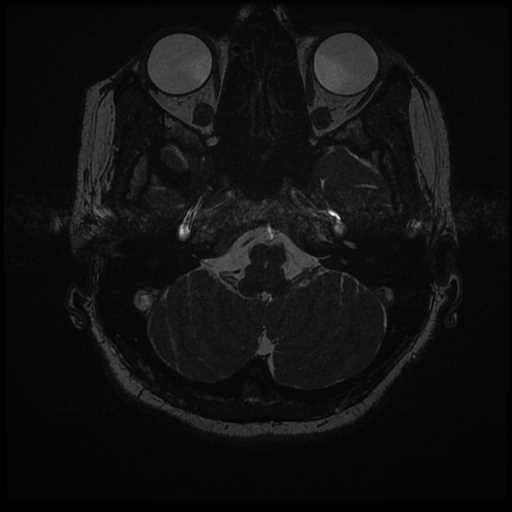 Anterior inferior cerebellar artery vascular loop - type II (Radiopaedia 70991-81209 Axial 3D FIESTA 60).jpg