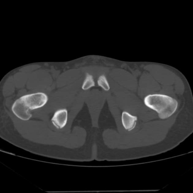 Anterior inferior iliac spine avulsion fracture (Radiopaedia 49469-54627 Axial bone window 51).jpg