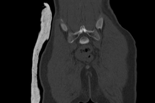 Anterior inferior iliac spine avulsion injury (Radiopaedia 88666-105376 Coronal bone window 61).jpg