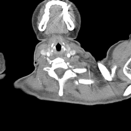 Anterior mediastinal lymphoma (Radiopaedia 29556-30061 C 1).jpg