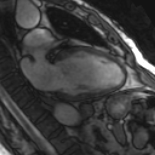 File:Anteroseptal hypokinesia after myocardial infarction (Radiopaedia 15978-15633 2 chamber view SSFE 23).jpg