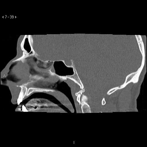 File:Antrochoanal Polyp (Radiopaedia 70510-80631 Sagittal bone window 29).jpg