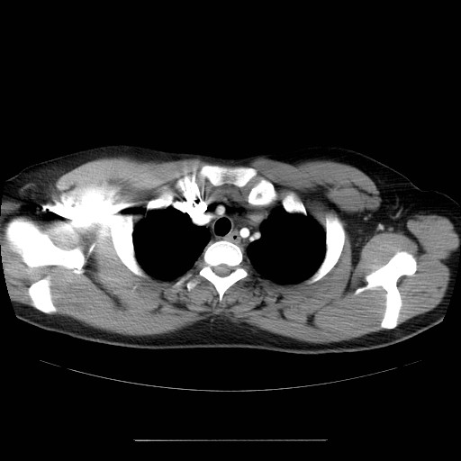 File:Aortic arch stent (Radiopaedia 30030-30595 D 4).jpg