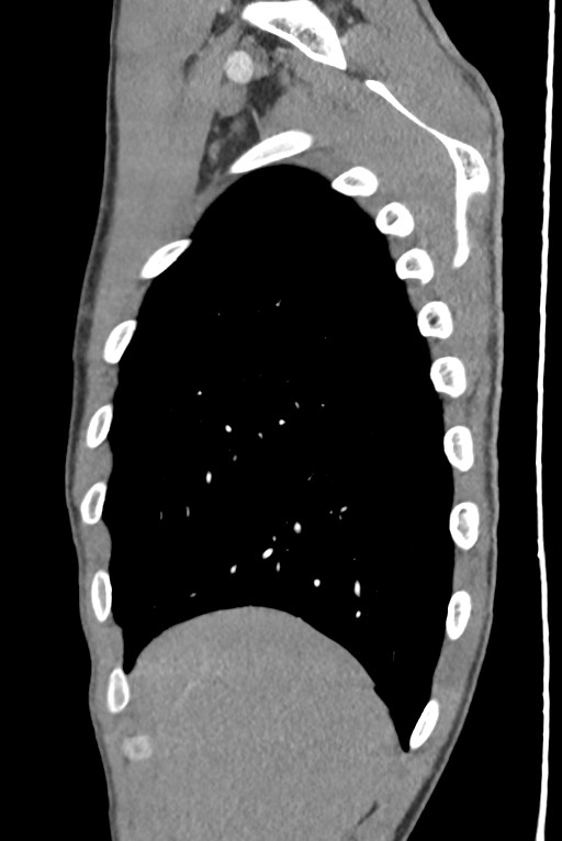 Aortic coarctation with aneurysm (Radiopaedia 74818-85828 B 31).jpg