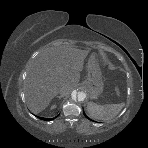 File:Aortic dissection- Stanford A (Radiopaedia 35729-37268 B 25).jpg